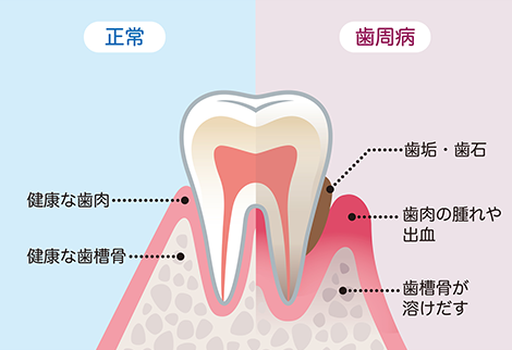 歯周病